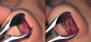 Bloedvaatje dichtbranden